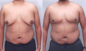 Gynecomastia
